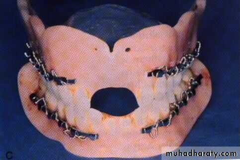 Facial fractures