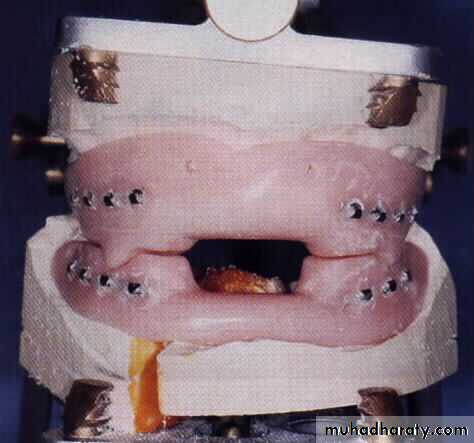 Facial fractures