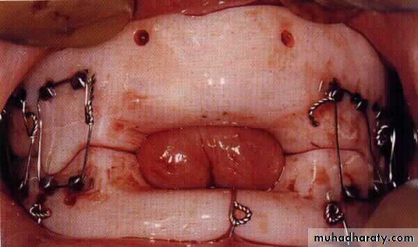 Facial fractures