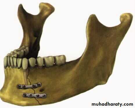 Facial fractures