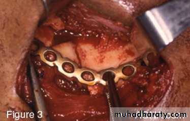 Facial fractures