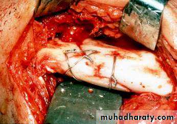 Facial fractures
