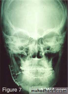 Facial fractures