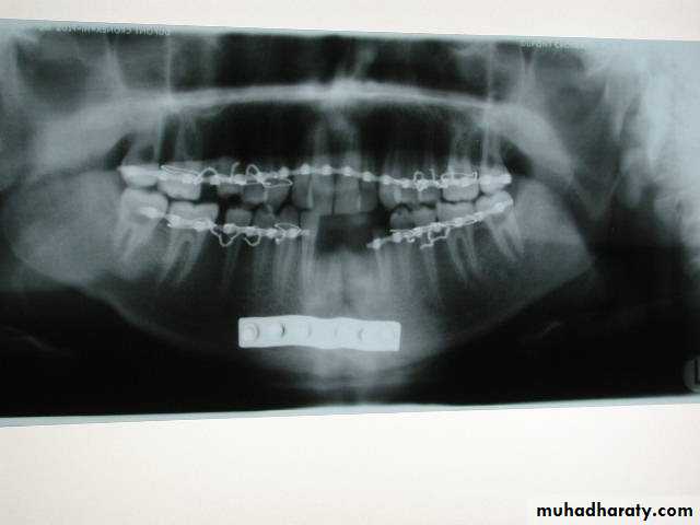 Facial fractures