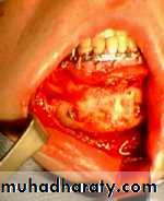 Facial fractures