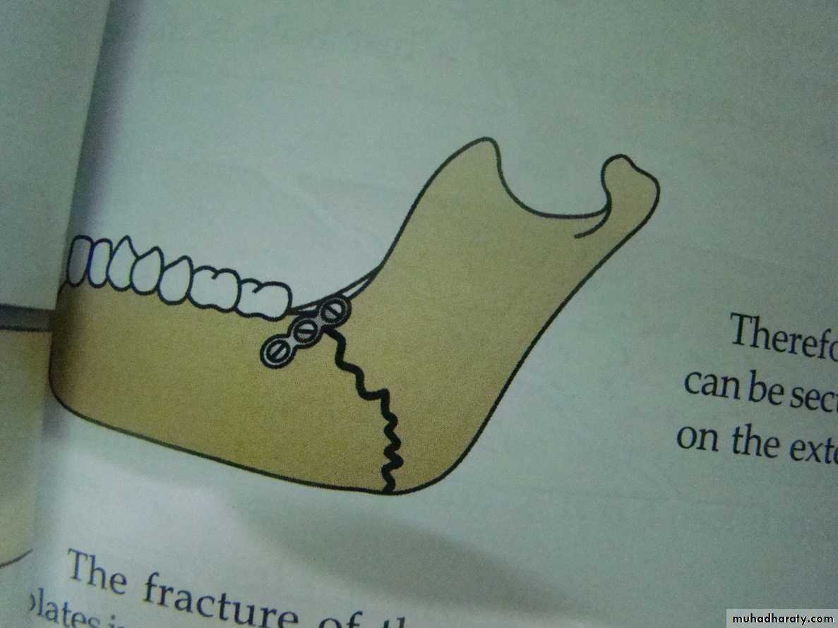 Facial fractures