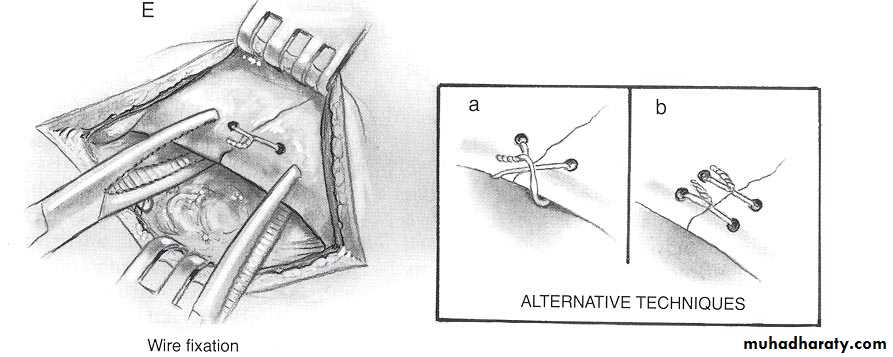 Facial fractures