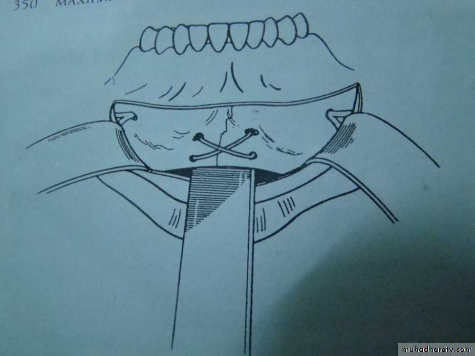 Facial fractures