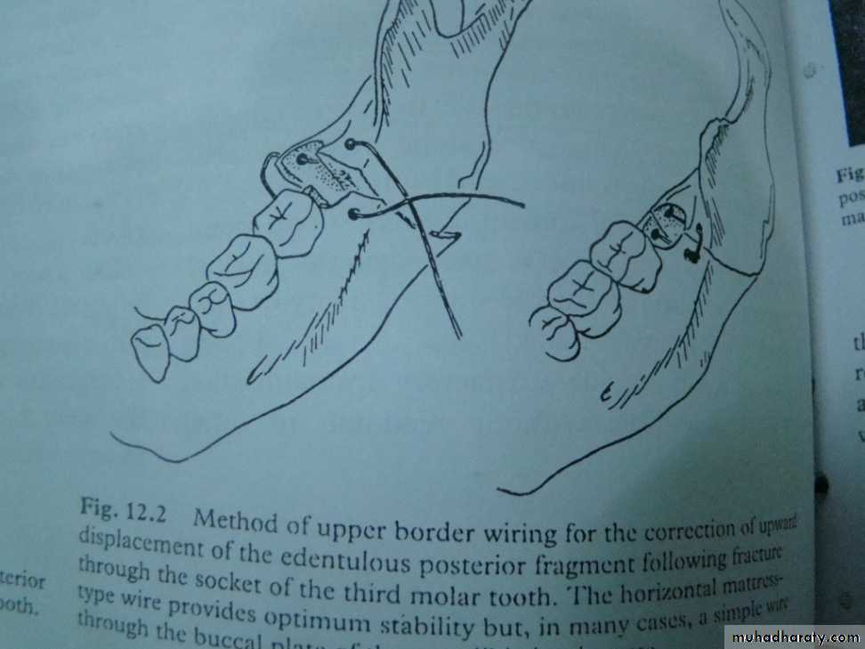 Facial fractures