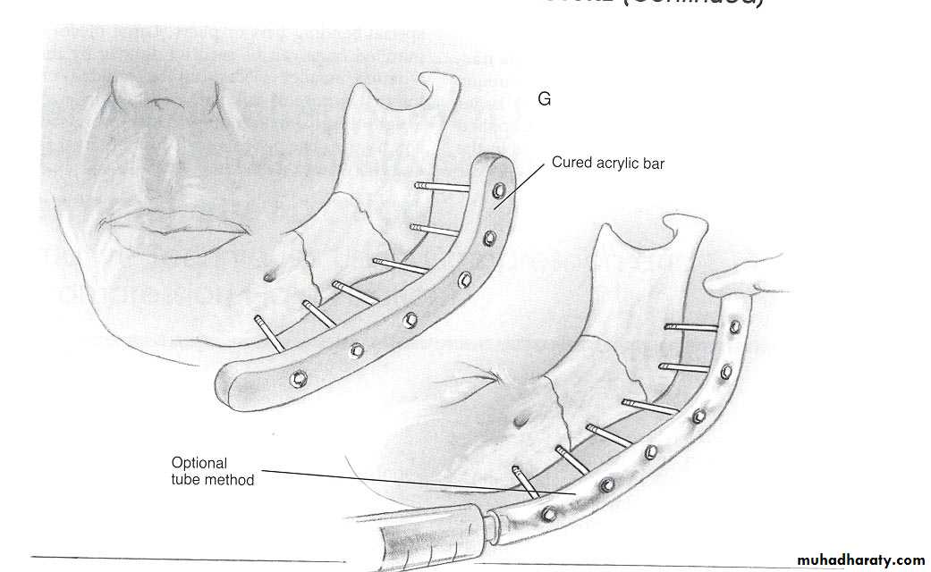 Facial fractures