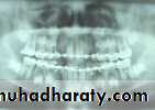 Facial fractures