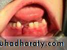 Facial fractures