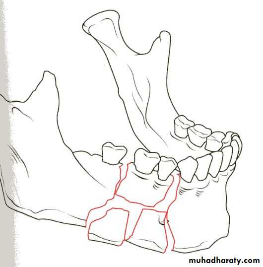 Facial fractures