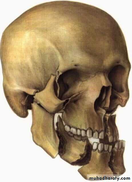 Facial fractures