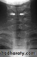 larynx