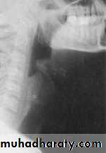 larynx