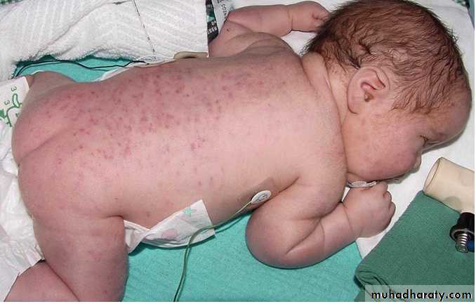 IMMUNOPATHOLOGY