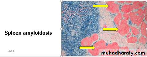 Amyloidosis