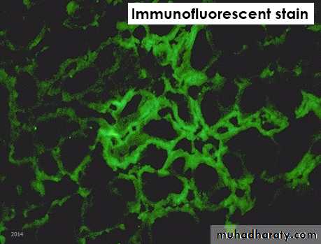 Amyloidosis