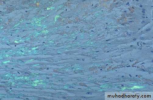 Amyloidosis