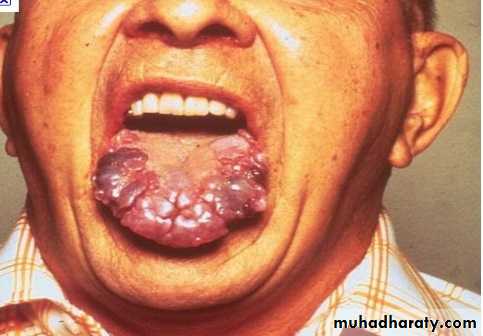 Amyloidosis