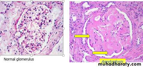 Amyloidosis