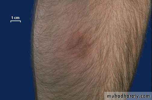 infectious disease