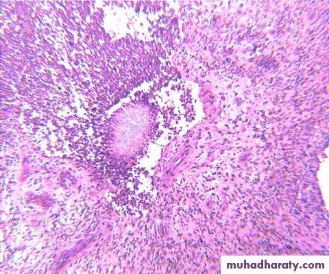 infectious disease