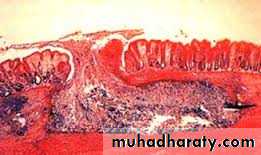 ENTAMOEBA HISTOLYTICA