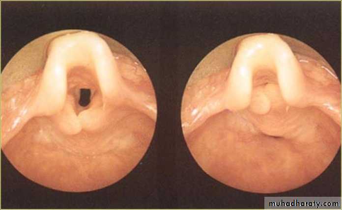 larynx