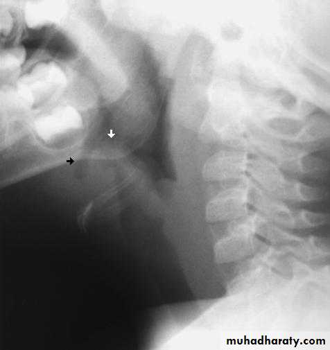 larynx