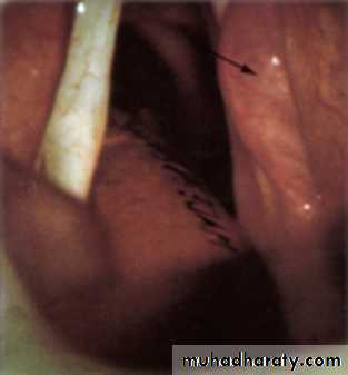 larynx