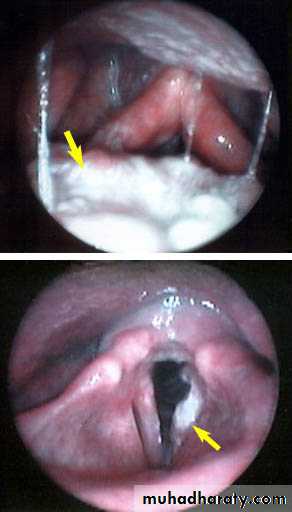 larynx