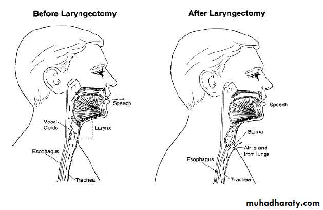 larynx