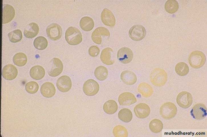 Red Blood Cells Disorders