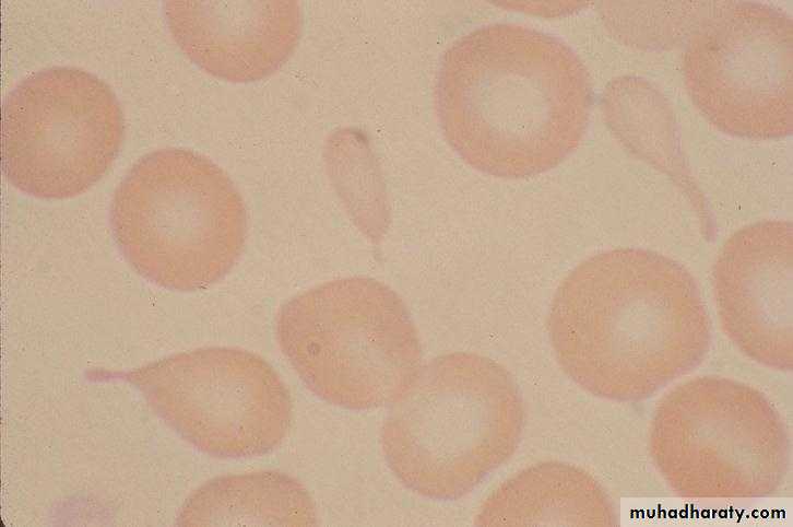 Red Blood Cells Disorders