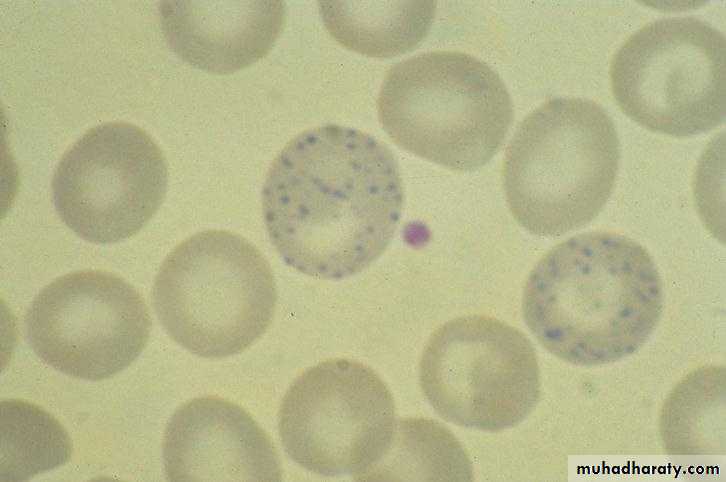 Red Blood Cells Disorders