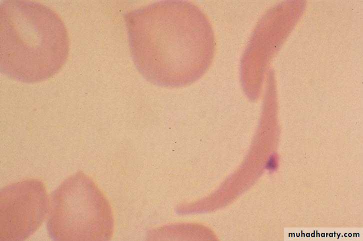 Red Blood Cells Disorders