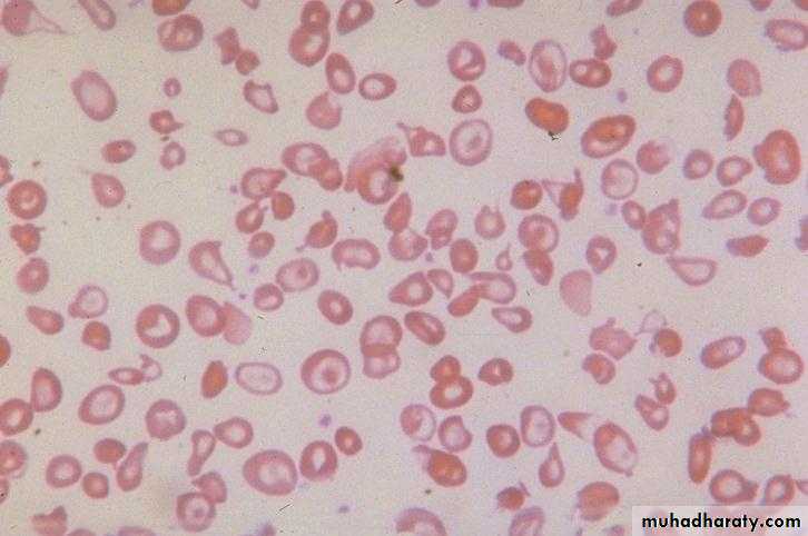 Red Blood Cells Disorders
