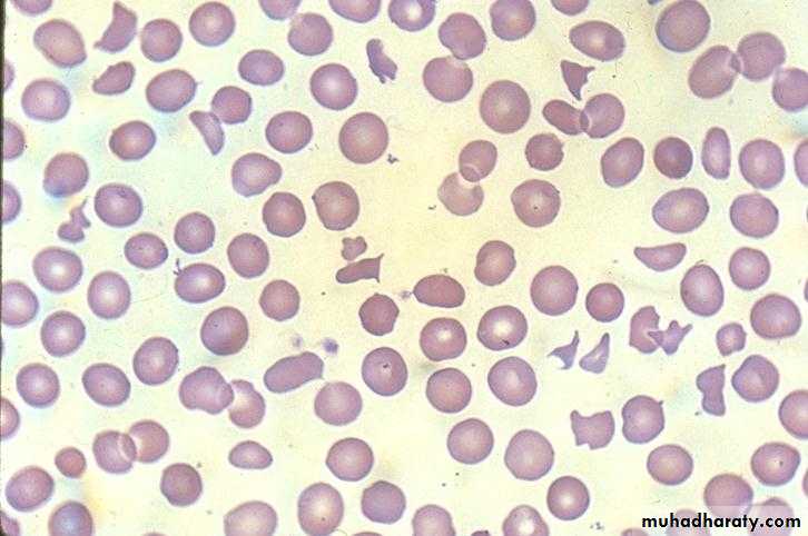 Red Blood Cells Disorders