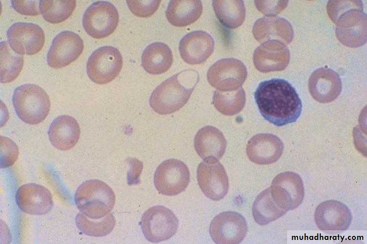 Red Blood Cells Disorders