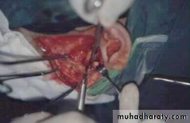 condylar injury