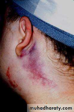 condylar injury