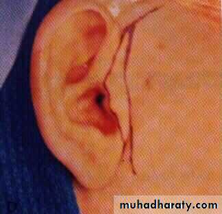 condylar injury