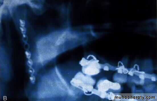condylar injury
