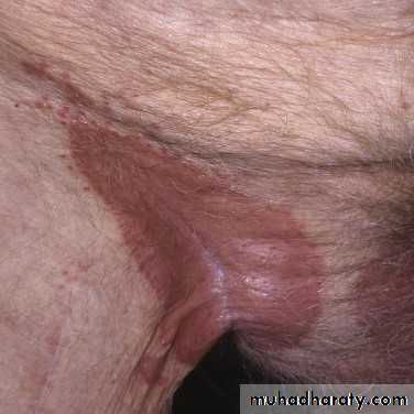 psoriasis