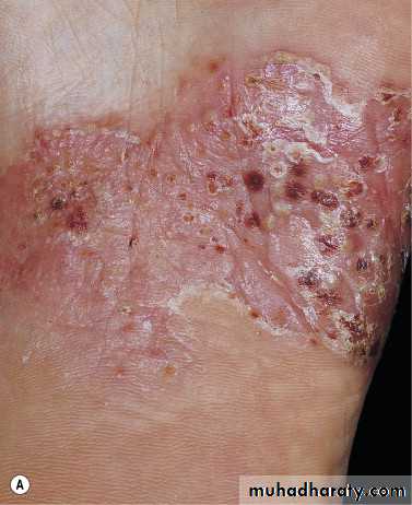 psoriasis