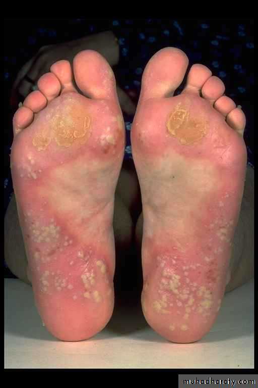 psoriasis