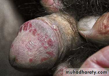 psoriasis