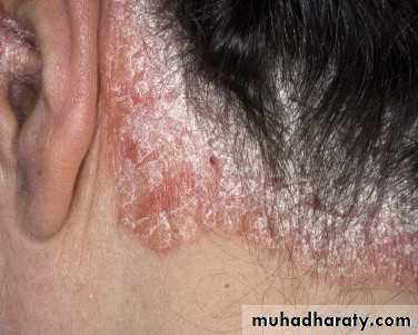 psoriasis